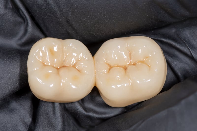 ceramic-metal crown, veneer close-up macro. Human tooth molar prosthesis